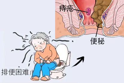 便秘图
