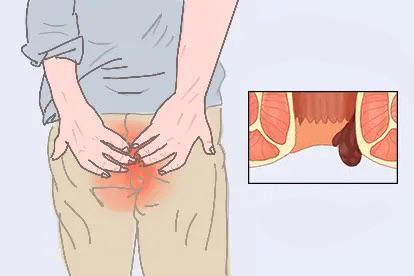 肛门突出物图