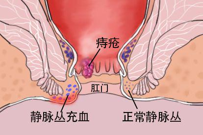 肛门疼痛图