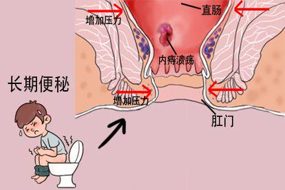 长期便秘图