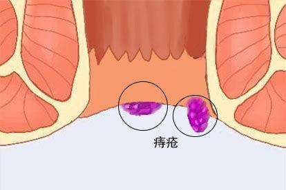痔疮图