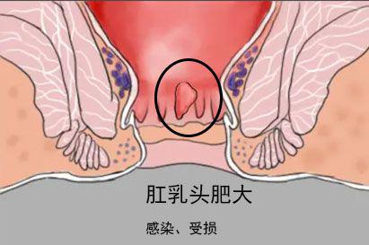 肛乳头肥大图片