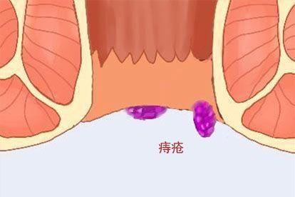 痔图片
