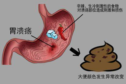 胃溃疡图片
