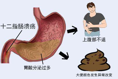 十二指肠溃疡图片