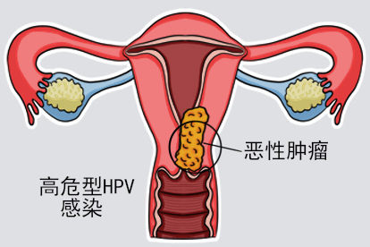 女性感染hpv恶性肿瘤照片