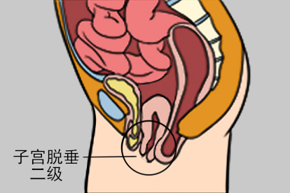 子宫脱垂二级图片