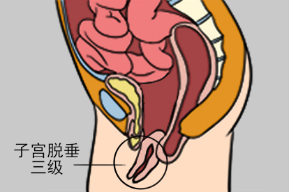 子宫脱垂三级图片