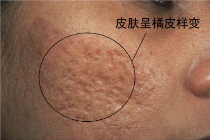粉刺癌图片