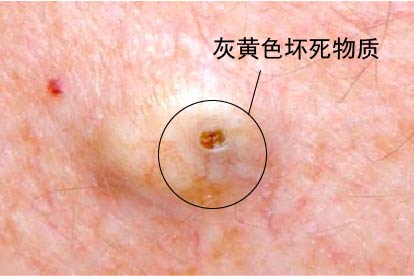 粉刺癌图片