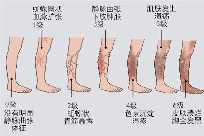 腿部静脉曲张0到6级照片