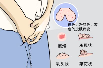 男性阴囊尖锐湿疣初期图片