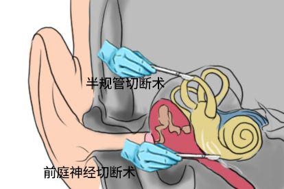 手术治疗图