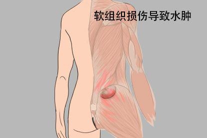 软组织损伤图