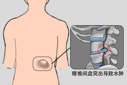 腰椎间盘突出图