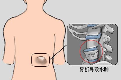 骨折图