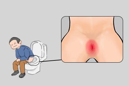 肛门疼痛图