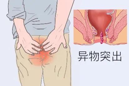 肛门有突出物图
