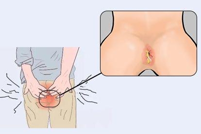 肛门瘙痒图