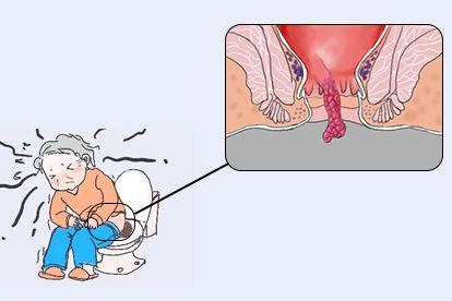 排便困难图
