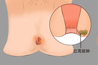 肛周脓肿图