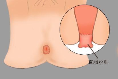 直肠脱垂图