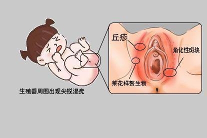 尖锐湿疣图