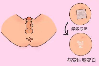 醋酸检查图