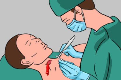 甲状腺结节4A类手术图