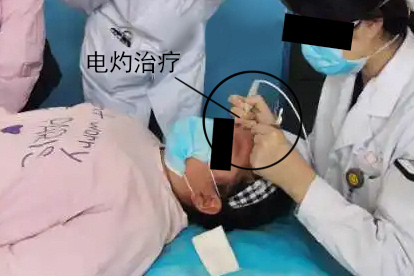 猴刺物理治疗图片