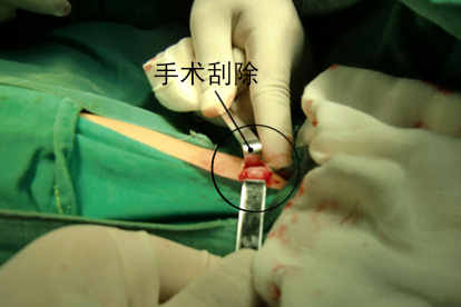 猴刺手术治疗图片