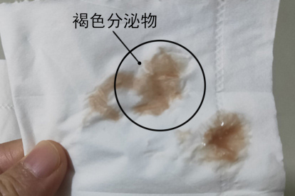 月经延迟二十天有褐色分泌物图片
