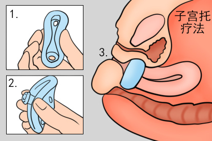 阴道壁膨出子宫托治疗方法图
