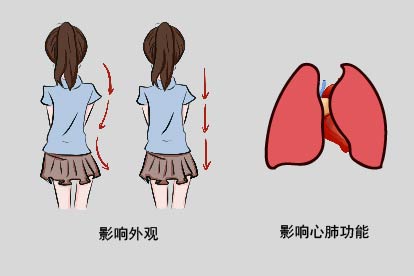 脊柱侧凸危害图片
