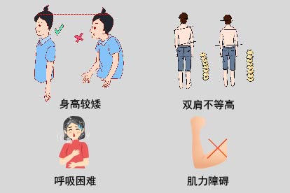 脊柱侧凸症状图片