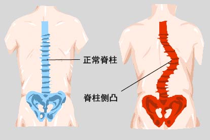 脊柱侧弯的危害和症状图片