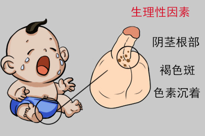 小孩阴茎根部褐色斑生理性因素图
