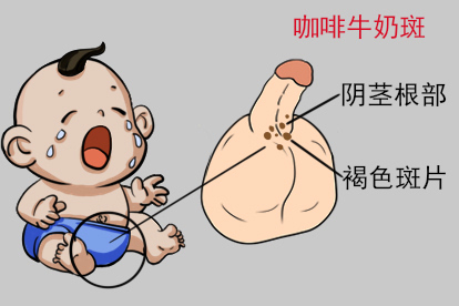 小孩阴茎根部咖啡牛奶斑图