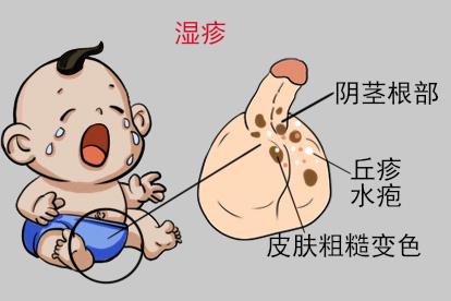 小孩阴茎根部褐色斑湿疹图