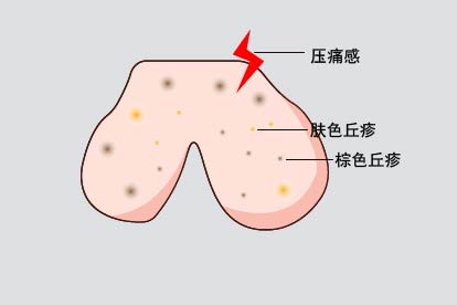 阴囊上长瘊子图