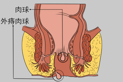 痔的肉球图片