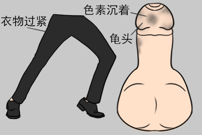 龟头上黑色素沉积生理性因素照片