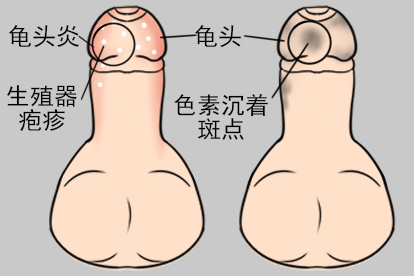 龟头上黑色素沉积色素沉着照片