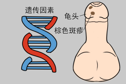 龟头上黑色素沉积色素痣照片