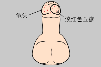 龟头上长了珍珠样阴茎丘疹图片
