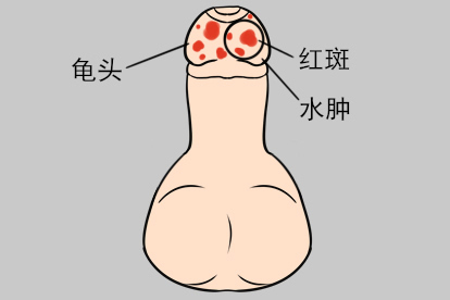 龟头上长了龟头炎图片