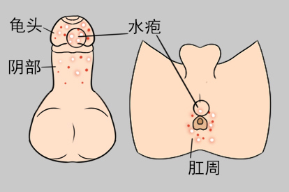 龟头上长了生殖器疱疹图片