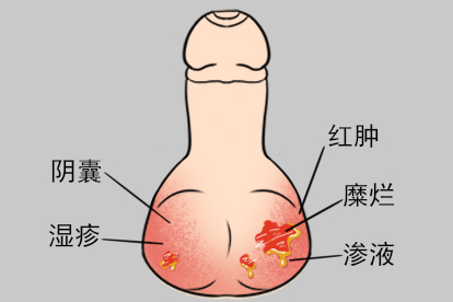 阴囊部位的湿疹溃烂图片
