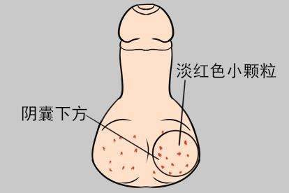 男性阴囊下面尖锐湿疣初期图片