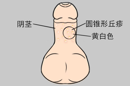 阴茎上面长粉刺图片
